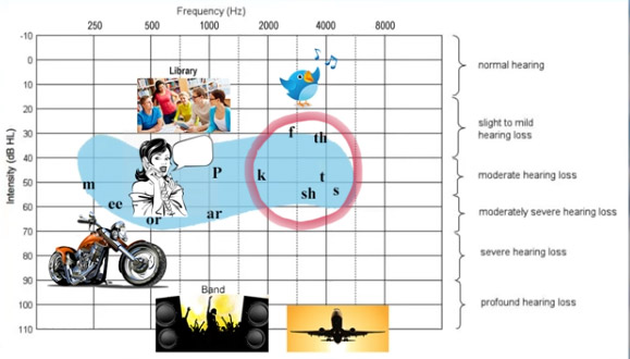 Consonant Sounds On An Audogram